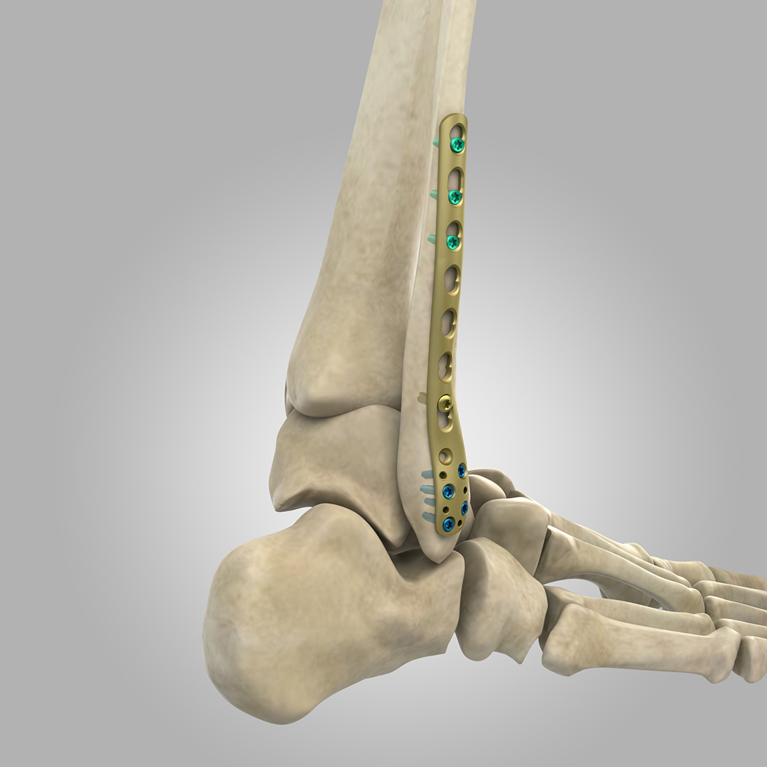 PLACA LCP PERONE DISTAL LATERAL