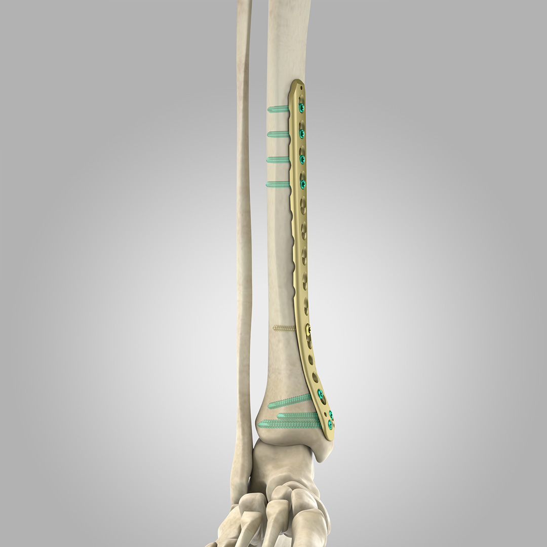 PLACA LCP TIBIA DISTAL MEDIAL