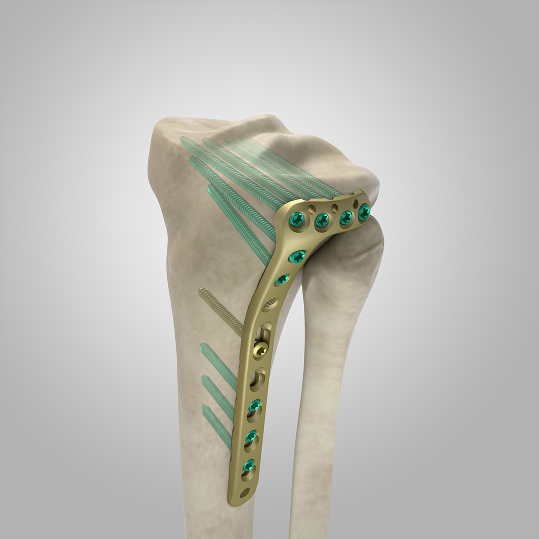 PLACA LCP TIBIA PROXIMAL L