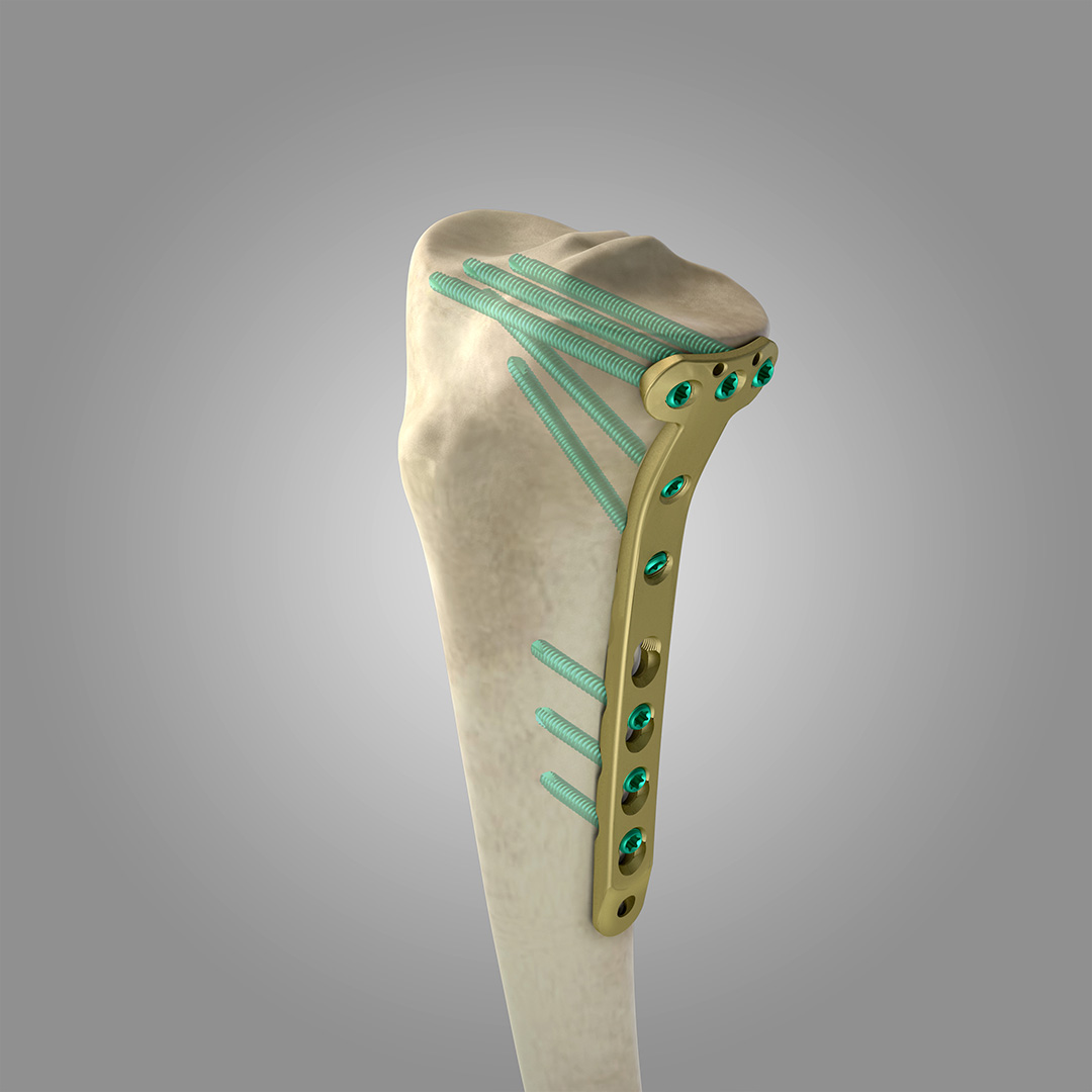 PLACA LCP TIBIA PROXIMAL MEDIAL T