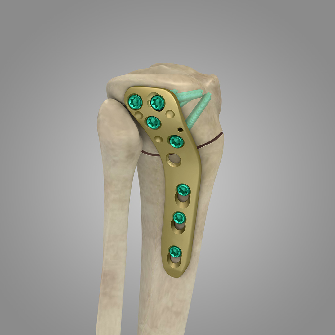PLACA OSTEOTOMIA TIBIAL LATERAL