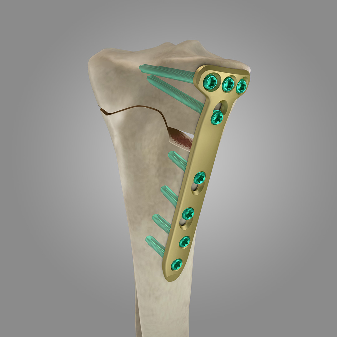 PLACA OSTEOTOMIA TIBIAL MEDIAL